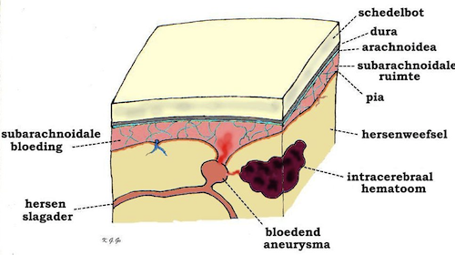 Intracerebrale bloeding