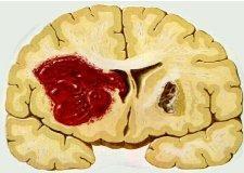 Intracerebrale bloeding