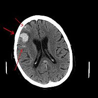 Intracerebrale bloeding scan